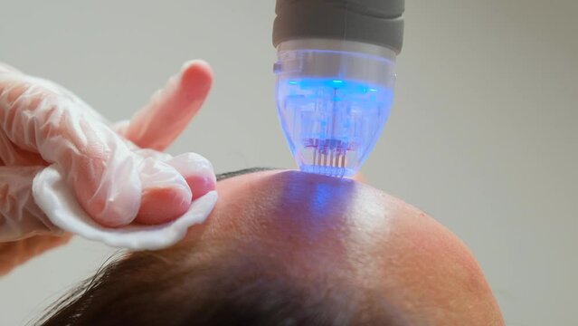 Procedure needle fractional RF for face lifting in a beauty clinic. 
