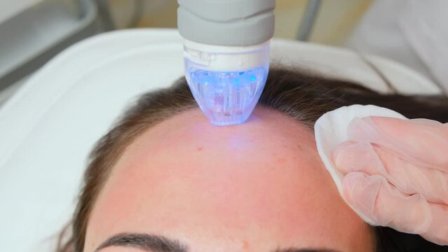 Procedure needle fractional RF for face lifting in a beauty clinic. Concept of beauty and cosmetology.