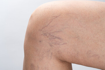 Varicose veins on female leg