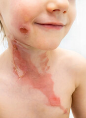 dressing a boy with a burn from boiling water