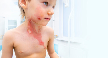 dressing a boy with a burn from boiling water