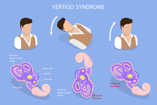 3D Isometric Flat Vector Conceptual Illustration of Vertigo Syndrome , BPPV