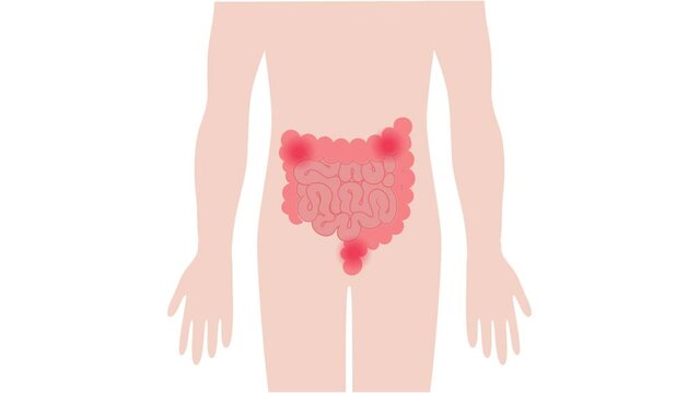Human body intestine pain crams due to indigestion constipation and bacteria medical animation