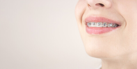 Portrait of a young girl with braces. Orthodontics, dentistry.