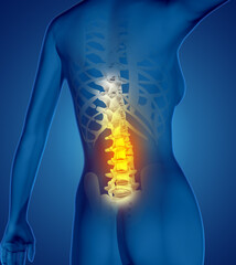 3D render of a female medical figure with spine highlighted