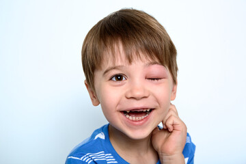 Child with swollen eye from insect bite. Face of allergic person. Allergy. Quincke edema. Portrait...
