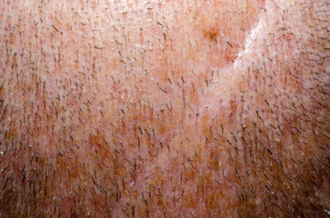 Trimmed hair on the head of an adult man close-up. scalp