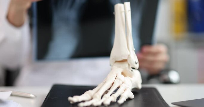 Anatomical model of the leg on the table, close-up. Consultation of a traumatologist surgeon