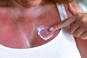 Young woman applying moisturizer on sunburned skin