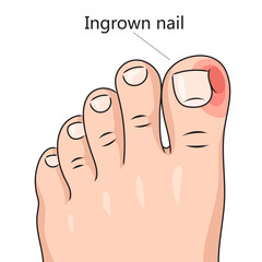 Ingrown nail onychocryptosis diagram schematic vector illustration. Medical science educational illustration