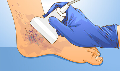 Human legs with health problems. Varicose veins. Diagnosis of varicose veins. Doppler (Duplex) ultrasound. Vector illustration. Healthcare illustration.  