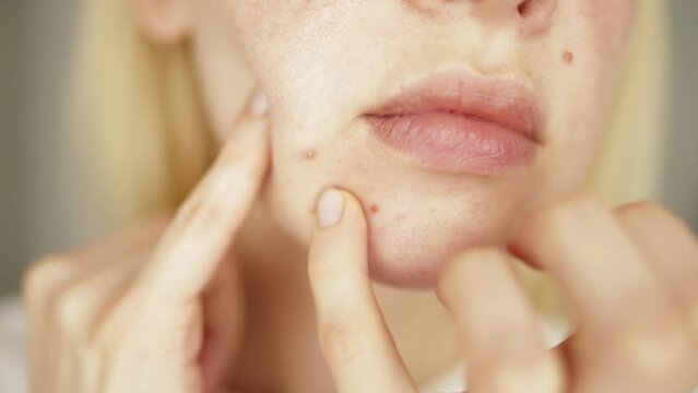 Problems face skin with acne and enlarged pores. Woman touching her face with her hands trying to squeeze a pimple