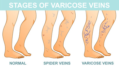 Human legs with health problems. Varicose veins. Stages of vein disease. Medical infographic. Vector illustration. Healthcare illustration. 