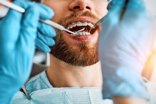 Cropped image of checking the teeth of a patient with braces. Dental clinic, dental treatment care.