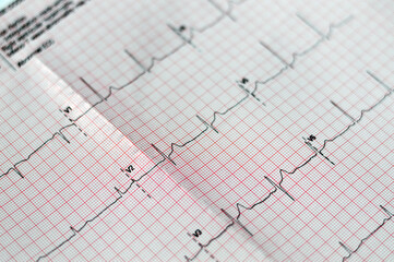 ECG ElectroCardioGraph paper that shows sinus rhythm abnormality of right ventricular hypertrophy,...