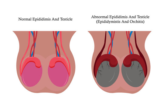 illustration comparation of normal epididimis and testis, and abnormal epididimis and testis (epididimitis orchitis). eps 10
