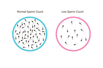 normal and low sperm count illustration. Male infertility oligospermia. Structure of the sperm. Vector. eps 10