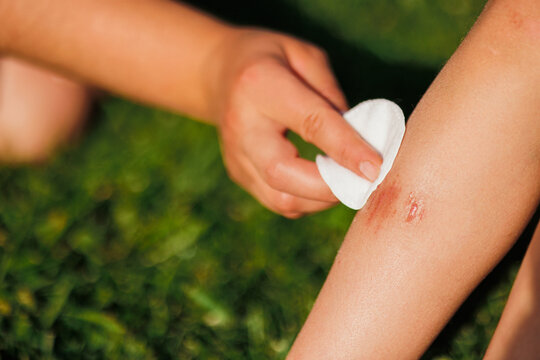 A woman's hand heals a child's wound below the knee. The child is sitting on the green grass in the summer. Treatment of the wound. First aid. Close-up photo