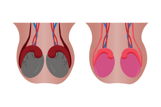 illustration comparation of normal epididimis and testis, and abnormal epididimis and testis (epididimitis orchitis). eps 10