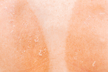 Young woman got sunburn and tan lines on his back. Skin hurt from sun burn and flakes sloughs off. Burning pain. Close-up back view.