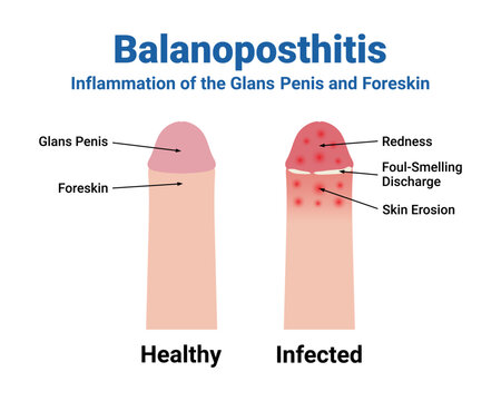 Balanoposthitis Medical Vector Illustration