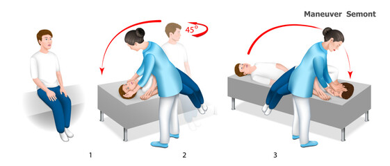 Semont maneuver is performed help of a doctor