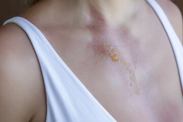 A second-degree burn with blister on woman's chest	