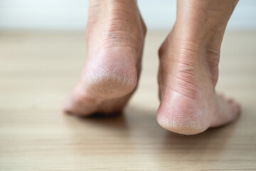 Dry cracked woman's heel standing on wooden floor
