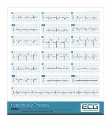 Male, 65 years old, admitted to hospital with chest pain for 2 hours. ECG showed hyperacute T waves. Coronary angiography showed occlusion of the middle segment of left anterior descending artery.