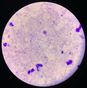 malaria parasite plasmodium falciparum on a thick blood smear reading under a microscope