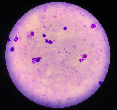 malaria parasite plasmodium falciparum on a thick blood smear reading under a microscope