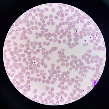 Abnormal cell macro ovalocyte.