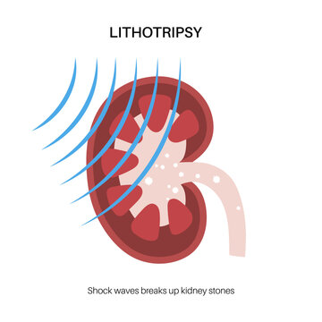 Lithotripsy procedure concept