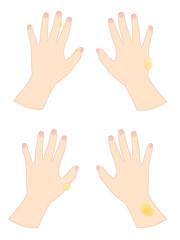 A hand with blisters 1