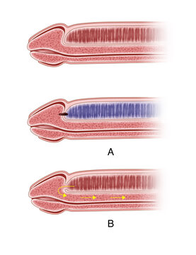 Cavernous shunt is one of the surgeries used to treat priapism, in which the head of the penis is perforated and drained within the penis to reduce bruising.