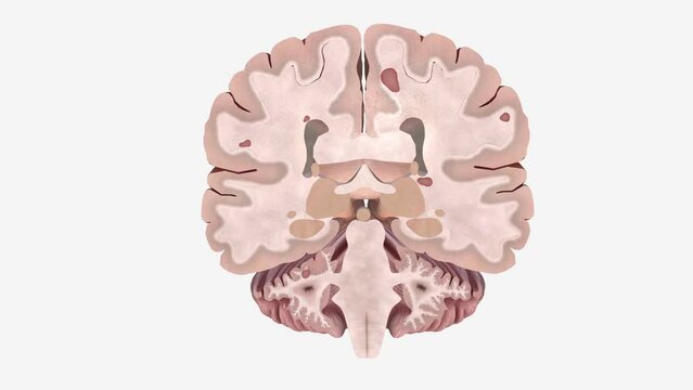 Brain lesions are areas of damaged brain tissue