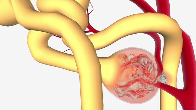 gA nephropathy is a common form of glomerulonephritis caused by the deposition of IgA immunoglobulins
