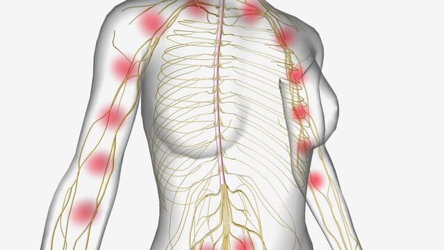 Central Sensitization Heightened sensitivity along spinal cord