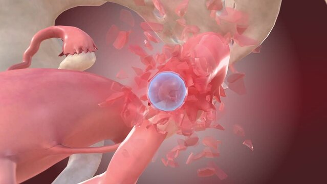 Ectopic pregnancy embryo causes tube rupture