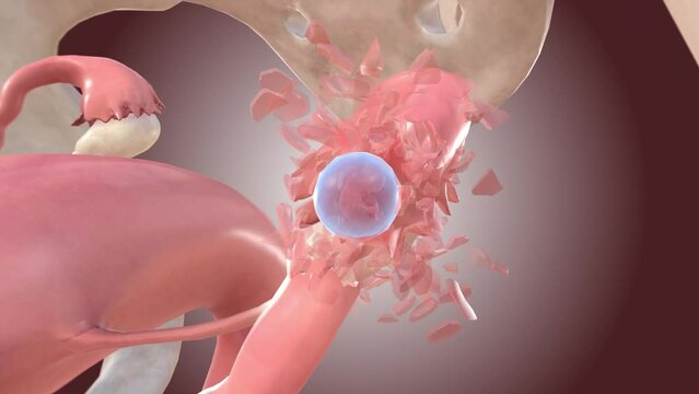 Ectopic pregnancy embryo causes tube rupture