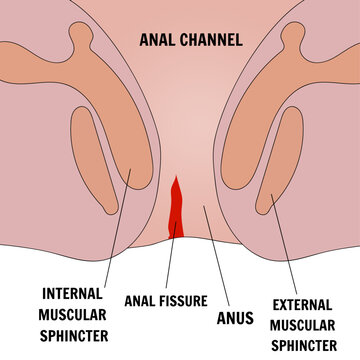 Anal fissure hemorrhoids disease in vector illustration 