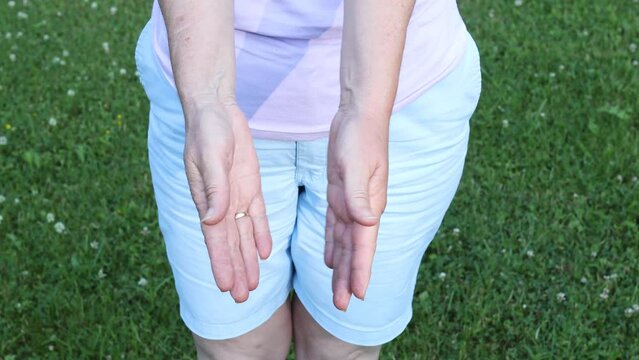 Swollen palm due to a bee sting. A woman showing her swollen hands. Showing both hands to compare swollen with non-swollen. Hands close up.