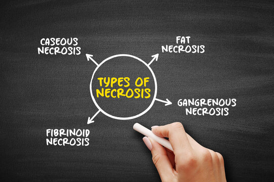Types of Necrosis (death of body tissue) mind map text concept for presentations and reports