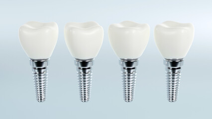 3d rendering of tooth implants with ceramic crowns on color background, Modern dental surgery concept