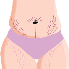 Belly with stretch marks. Striae after pregnancy. Overweight waist and legs. Postpartum Body in vector. Woman with fat in pink underwear.