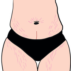 Belly with stretch marks. Striae after pregnancy. Overweight waist and legs. Postpartum Body in vector. Woman with fat in black underwear.