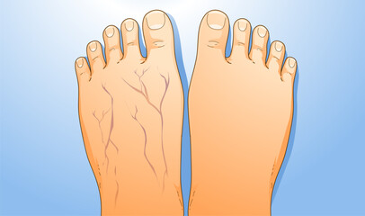 Human legs with health problems. Varicose veins. Before, after. Vector illustration. Healthcare illustration. 