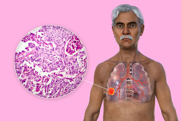A 3D illustration of the upper half part of a man with transparent skin, revealing the presence of lung cancer