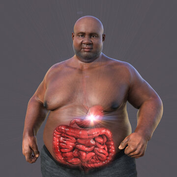 A detailed 3D medical illustration of an overweight man with transparent skin, revealing the digestive system