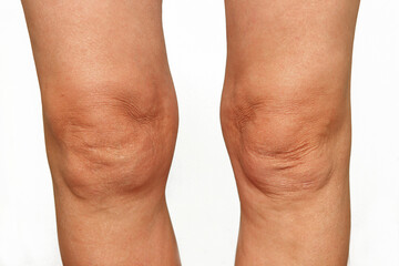 Arthrose im Knie